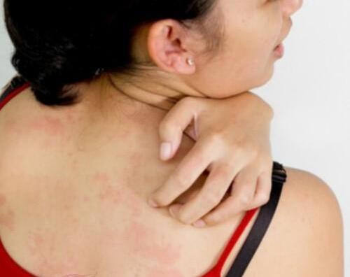皮膚過敏怎么辦，該如何治療