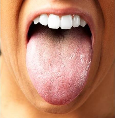 舌苔发白是什么原因，如何预防