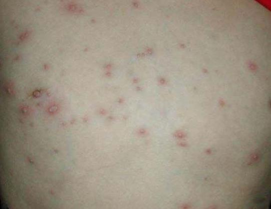什么是水痘，水痘的發病原因詳解