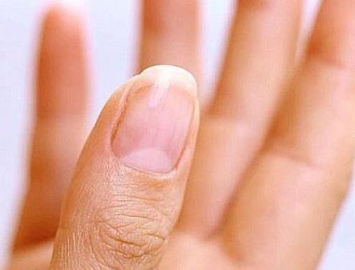 手指甲上月牙少说明什么，月牙和健康的联系