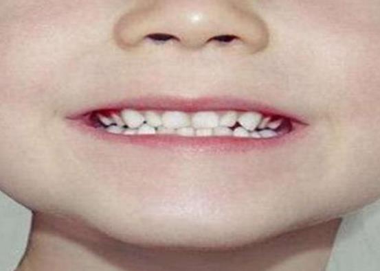 磨牙是缺钙吗，睡觉磨牙的8个原因
