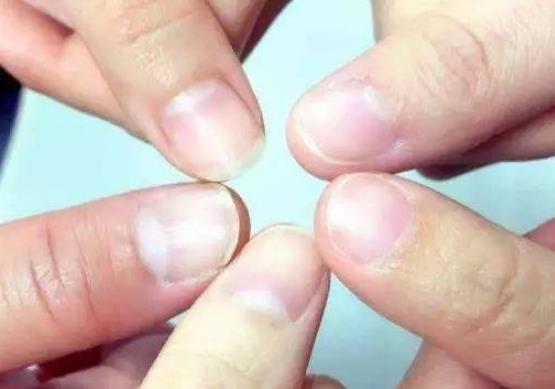手指上的月牙消失怎么回事，如何调理