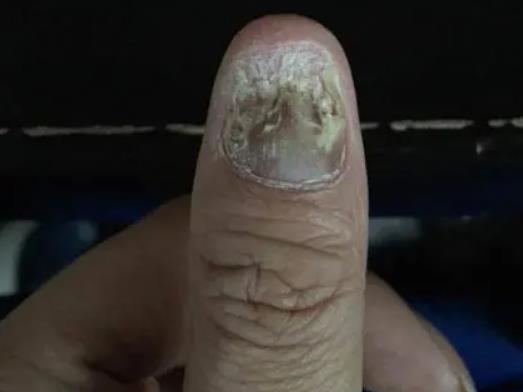 灰指甲对身体有影响吗，灰指甲的危害